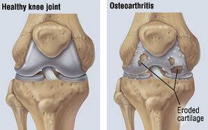 Healthy cartilage vs osteoarthritic cartilage [13]