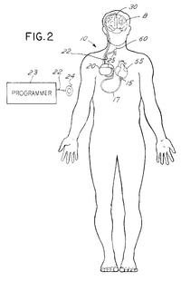VNS with Limited Effect on Heart Drawing