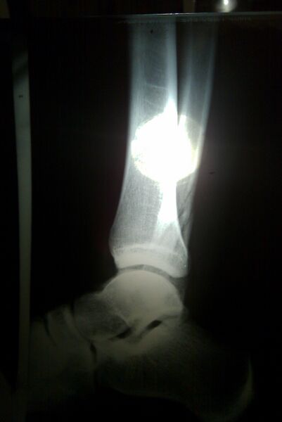 File:Joseankle.jpeg