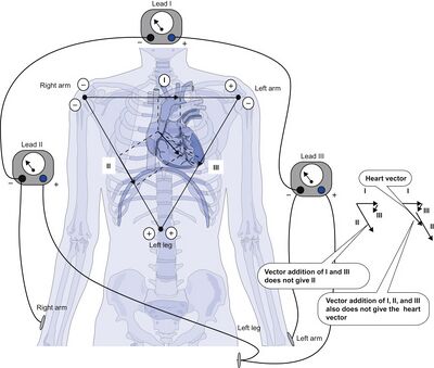 Leads I, II and III are placed at 60° to each other, forming Einthoven's triangle [19]