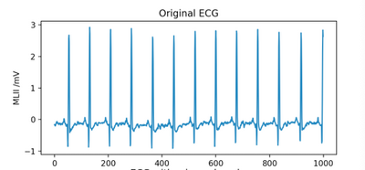 Figure 2.5b: Original ECG of Patient with Normal Sinus Rhythm