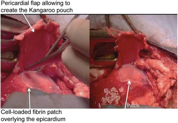 Fibrin patch[15]