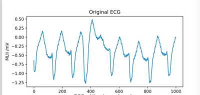 Figure 2.5f: Original ECG of Patient with Malignant Ventricular Ectopy