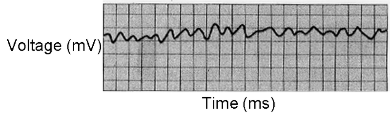 File:Ventricular Fibrillation ECG S11.png