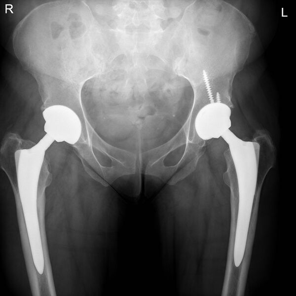 File:HIP-REPLACEMENT-XRAY.jpg