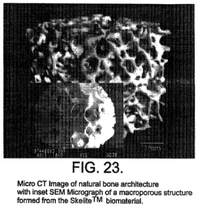 Warsaw Orthopedic's Patent