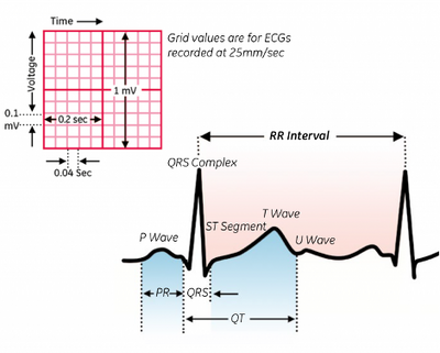 A typical ECG recording (Friederich,Patrick)[5]
