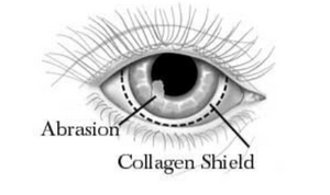 Application of a collagen shield on a cornea