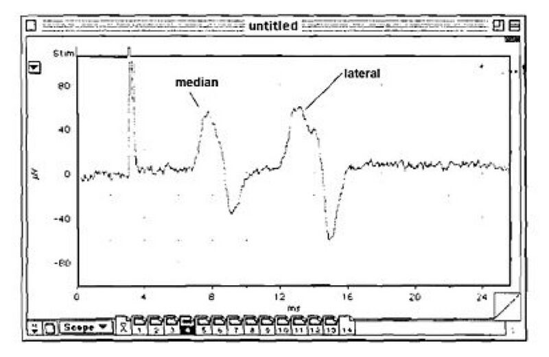 File:Median and lateral giant fibers.jpg