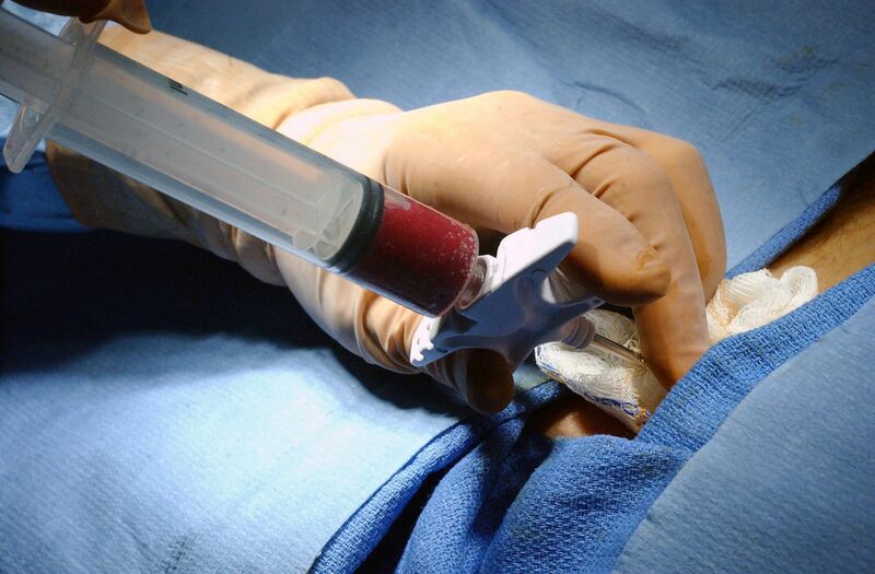 File:Bone marrow biopsy.jpg