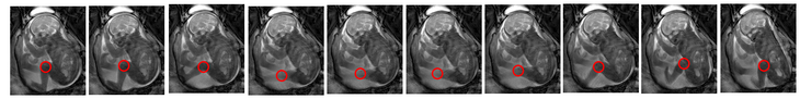 Fetal movements biomarker