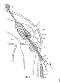MedicineLodge's Ligament Bone Anchor