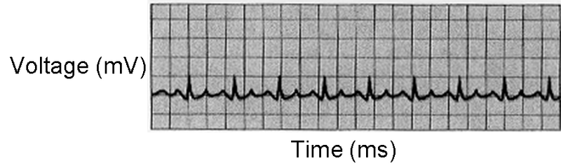File:Tachycardia ECG S11.png
