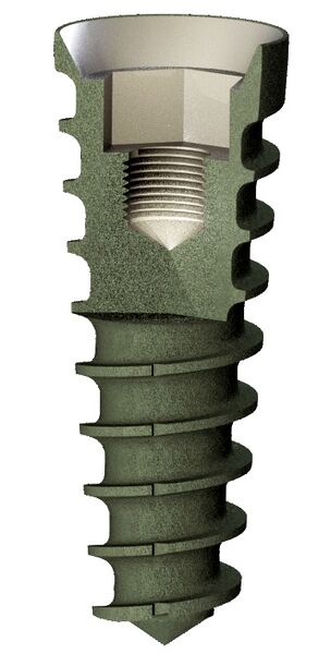 File:DentalImplant.jpg