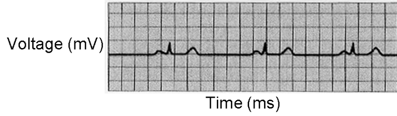 File:Bradycardia ECG S11.png